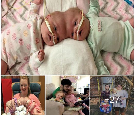Unbelievable Journey: Conjoined Twins Separated at Birth, Now Thriving as Toddler Siblings